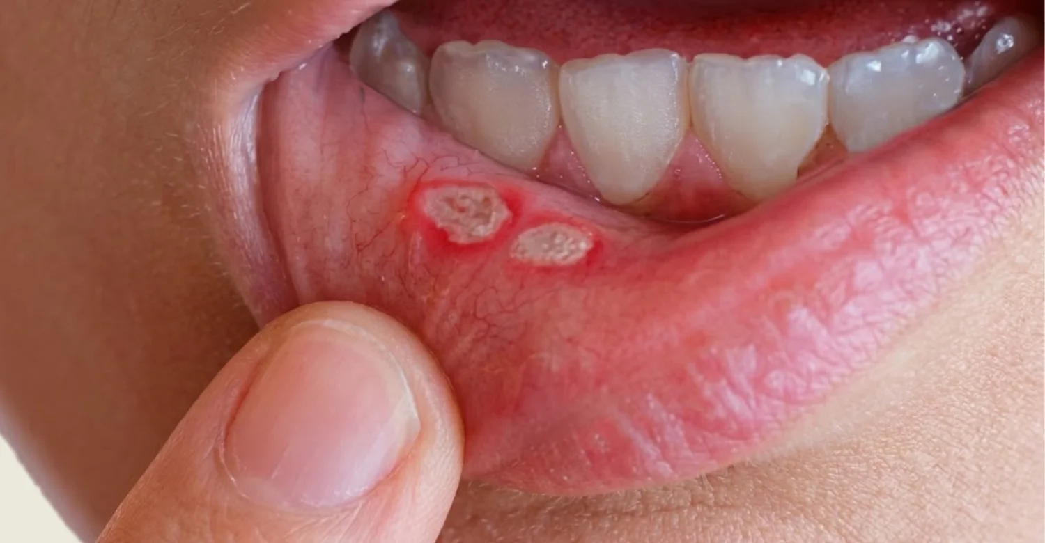 Mouth Ulcer 2